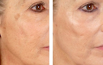 Active FX Fractional Laser Resurfacing