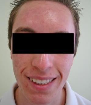 Laser Acne Treatment