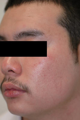 Laser Acne Treatment