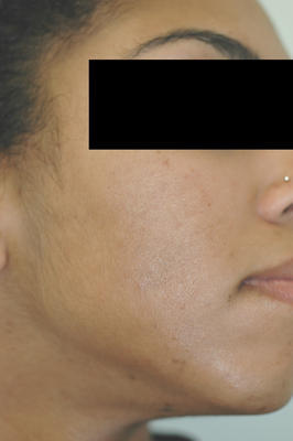Laser Acne Treatment