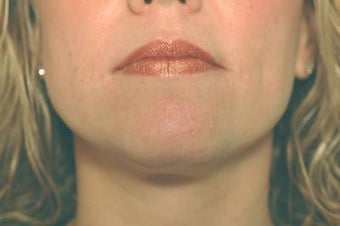 Laser Acne Treatment