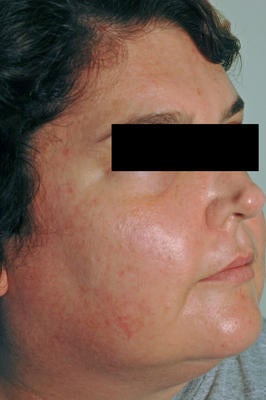 Laser Acne Treatment