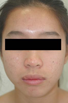 Laser Acne Treatment