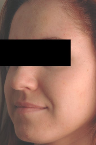 Hormonal Acne Treatment in Los Angeles