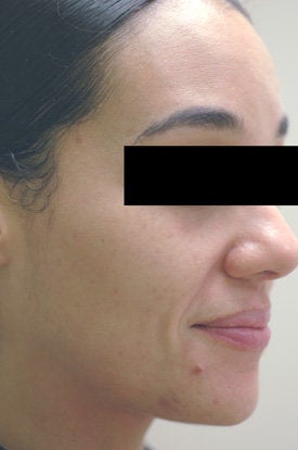 Acne Laser Treatment