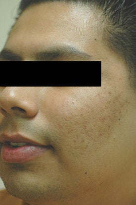 Acne Laser Treatment