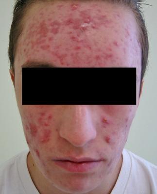 Laser Acne Treatment