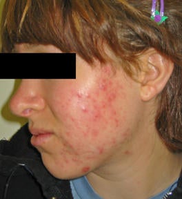 Laser Acne Treatments
