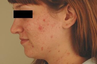 Laser Acne Treatment