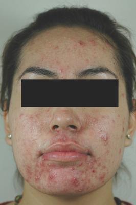 Laser Acne Treatment