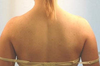Laser Back Acne Treatment