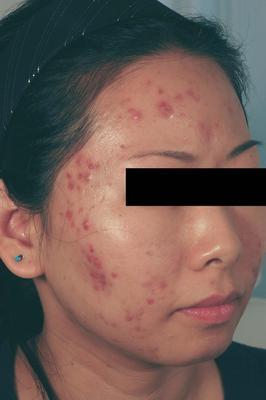 Laser Acne Treatment