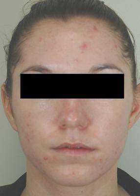 Laser Acne Treatment