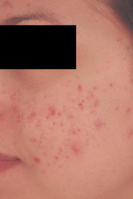 Laser Acne Treatment