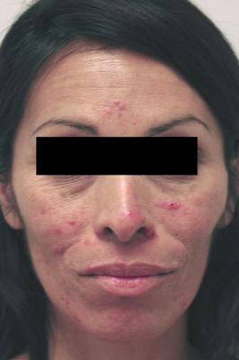 Laser Acne Treatment