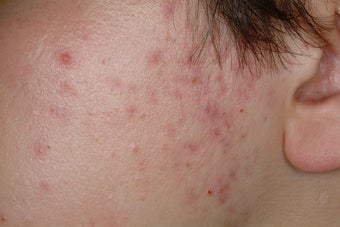 Laser Acne Treatment