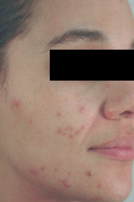Acne Laser Treatment