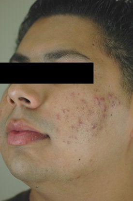 Acne Laser Treatment