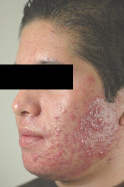 Laser Acne Treatment