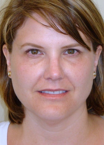 Active FX & Upper Eyelid Lift (Blepharoplasty)
