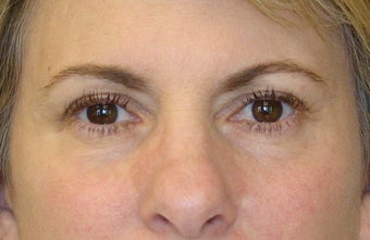 Active FX Laser Resurfacing