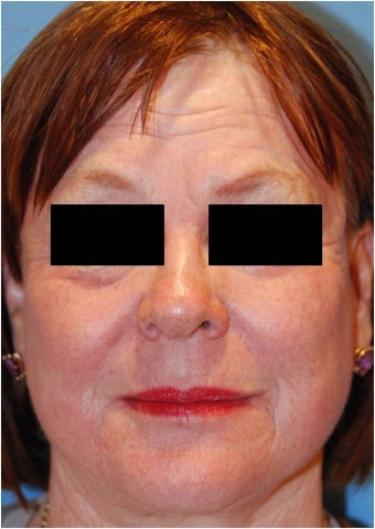 CO2 Laser Resurfacing ~ ActiveFX & DeepFX