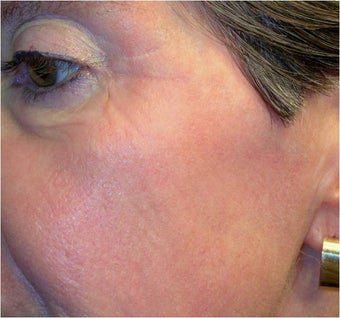 CO2 Laser Resurfacing ~ Active & DeepFX 