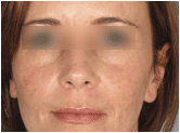 active fx fractional resurfacing
