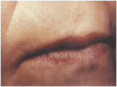 active fx fractional Co2 resurfacing
