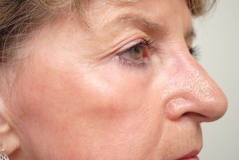 fractional CO2 resurfacing