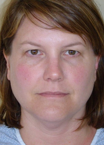 Active FX & Upper Eyelid Lift (Blepharoplasty)
