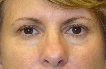 Active FX Laser Resurfacing