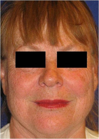 CO2 Laser Resurfacing ~ ActiveFX & DeepFX