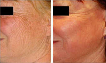 CO2 Laser Resurfacing ~ ActiveFX & DeepFX