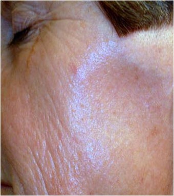 CO2 Laser Resurfacing ~ Active & DeepFX 