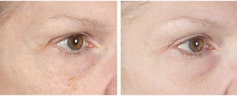 Active FX Fractional Laser Resurfacing