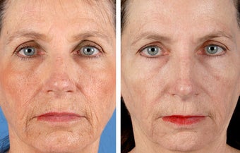 Active FX Fractional Laser Resurfacing