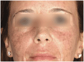 active fx fractional resurfacing