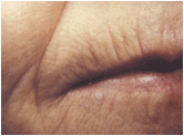 active fx fractional Co2 resurfacing