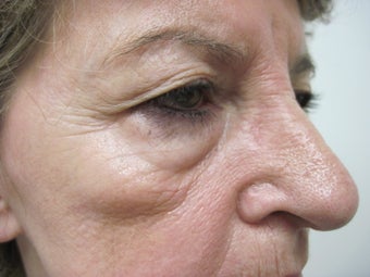 fractional CO2 resurfacing