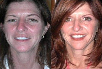 FX Laser Peel, Botox
