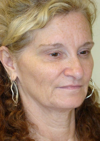 Total FX - Active FX and Deep FX face and neck treatment