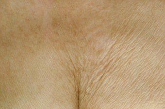 Affirm CO2 to Chest Area