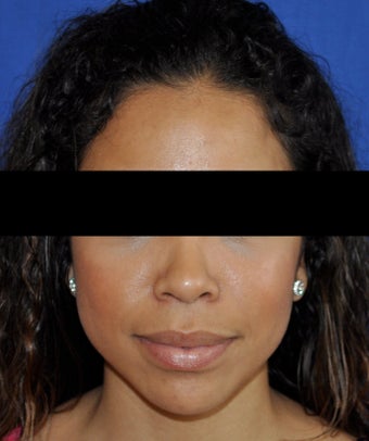 African American Rhinoplasty