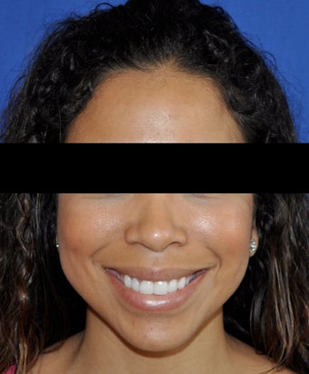 African American Rhinoplasty