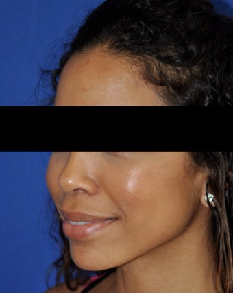 African American Rhinoplasty