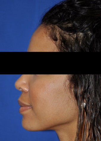 African American Rhinoplasty