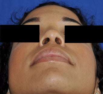 African American Rhinoplasty