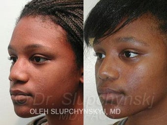 African American Rhinoplasty