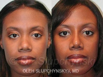 African American Rhinoplasty
